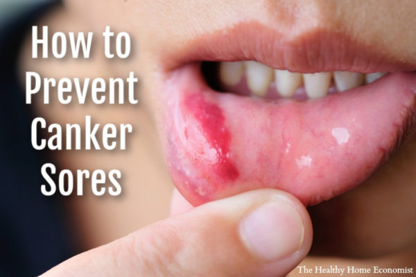 how-to-stop-canker-sores-forever-healthy-home-economist