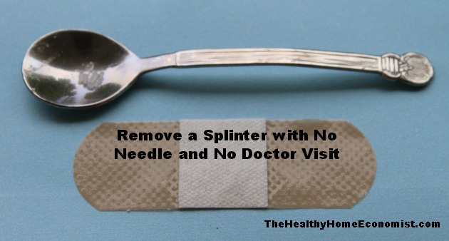 How to Remove a Stubborn Splinter with no Pain or Needles ...