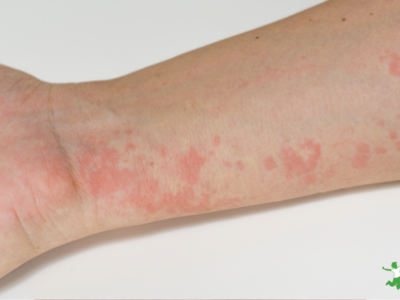 child with hives on left lower arm