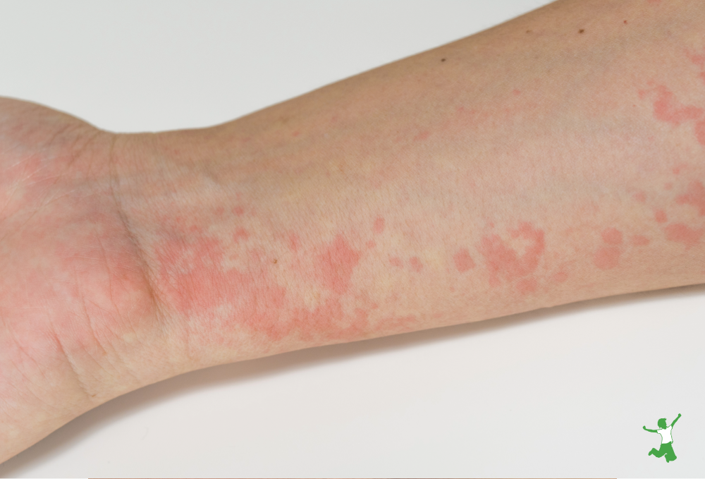 child with hives on left lower arm